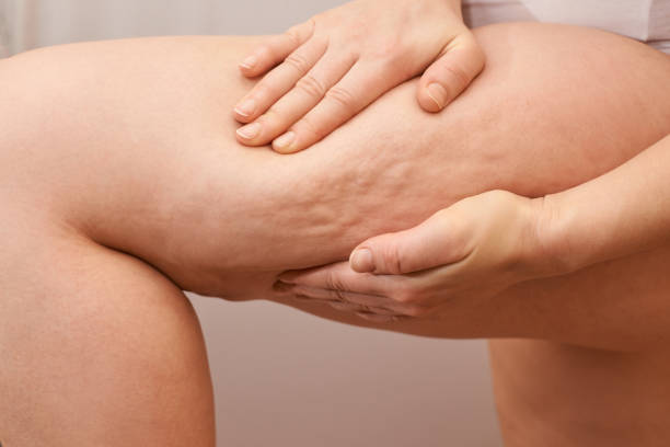 Know the Causes and Treatment of Cellulite on skin .