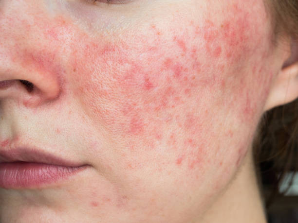 Rosacea Unveiled: Understanding Symptoms, Triggers, and Treatment Options.