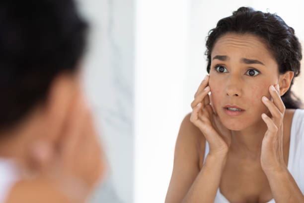 Understanding Eczema: Causes, Symptoms, and Treatment Options