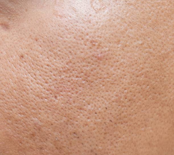 Gain insight into the Causes and Treatment of open pores